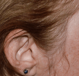 Photo from STYLE Study of a female Otezla patient's ear with ScPGA 0 at week 16