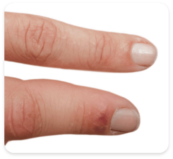Patient with swollen fingers from psoriatic arthritis
