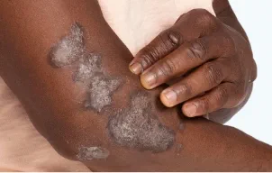 Image of plaque psoriasis which is a systemic disease that can extend beyond the surface of the skin