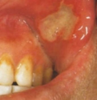 Close-up image of an actual major-type oral aphthous ulcer