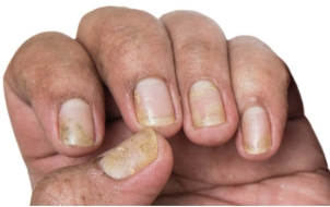 Image of nail psoriasis, which can manifest in several different ways in plaque psoriasis, including pitting and red spots, and is a difficult condition to treat