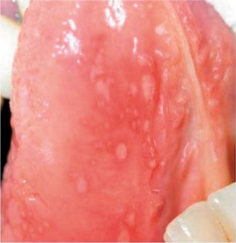 Close-up image of an actual oral aphthous ulcer