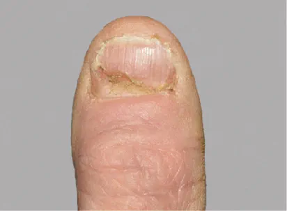 Photo from an Otezla patient's thumb at baseline