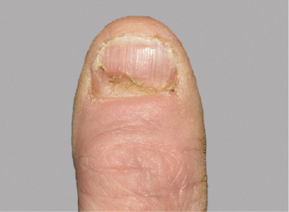 Photo from an Otezla patient's thumb at baseline