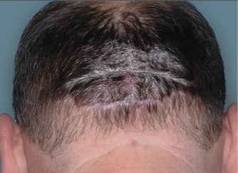 Photo from ESTEEM 1 Study of a male Otezla patient's neck at baseline