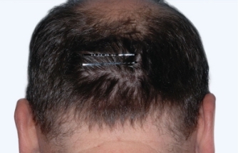 Photo from ESTEEM 1 Study of a male Otezla patient's neck with PASI-63 score at week 16