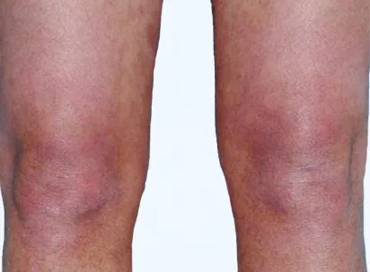 Photo from ESTEEM 1 Study of an Otezla patient's legs with PASI-85 score at week 16