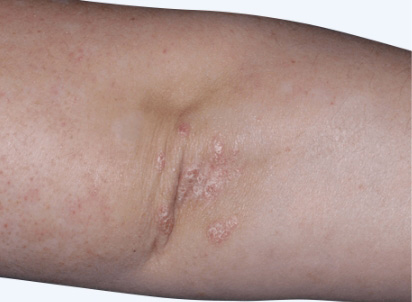 Photo from an ESTEEM study of an Otezla patient's elbow with PASI-70 result at week 16