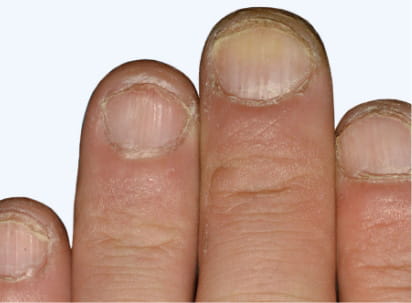 Photo from an Otezla patient's 4 fingers with NAPSI scores at week 16