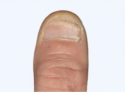 Photo from an Otezla patient's thumb with NAPSI scores at week 16