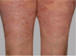 Photo from an Otezla patient's thighs with PASI-76.5 result at week 16