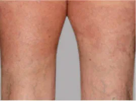Photo from an Otezla patient's thighs with PASI-90 result at week 32