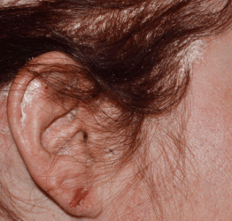 Photo from STYLE Study of a female Otezla patient's ear at baseline
