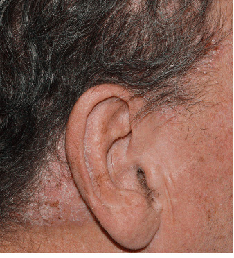 Photo from STYLE Study of a male Otezla patient's ear at baseline