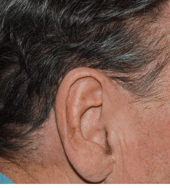 Photo from STYLE Study of a male Otezla patient's ear with ScPGA 3 at week 16