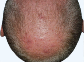 Photo from STYLE study of a male Otezla patient's scalp with ScPGA score at week 16