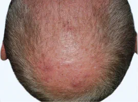 Photo from STYLE study of a male Otezla patient's scalp with ScPGA score at week 32