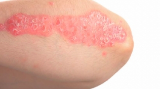 Photo of a patient's elbow with plaque psoriasis