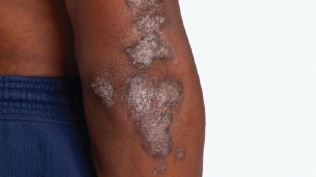 Photo of plaque psoriasis on arm