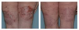Thumbnail of plaque psoriasis PASI-75 results at week 16 on the knees of an Otezla patient