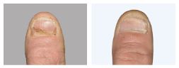 Thumbnail of plaque psoriasis PASI-76.5 results at Week 16 in the thumb of an Otezla patient