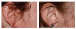 Thumbnail of plaque psoriasis STYLE results at week 16 on the ear of a femaie Otezla patient
