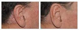 Thumbnail of plaque psoriasis STYLE results at week 16 on the ear of a male Otezla patient