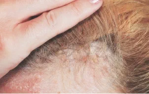 Image of scalp psoriasis which is characterized by red, thickened plaques along the hairline, on the forehead, ears, or on the back of the neck