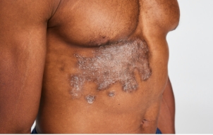 Image of plaque psoriasis which is characterized by flaking, scaling and itching of non-scalp areas