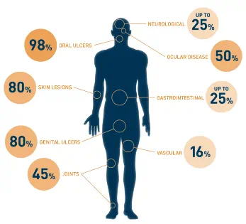 Diagram of a person and bubbles that represent the manifestations in Behçet's Disease with oral ulcers as the most frequently observed symptom