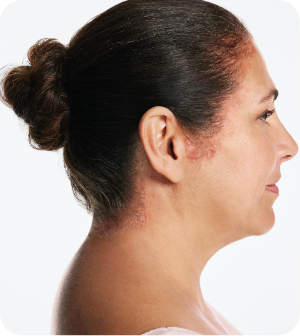 Photo of scalp psoriasis