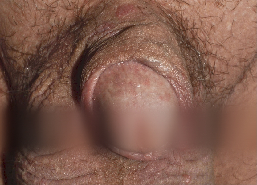 Baseline plaque psoriasis of the genital area