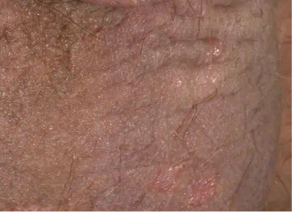 Baseline plaque psoriasis of the genital area