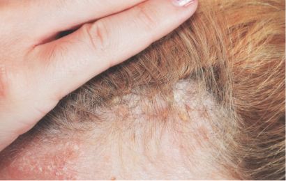 Plaque psoriasis patient with plaque on scalp