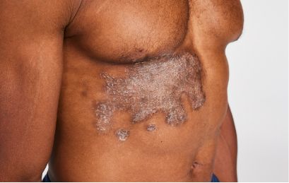 Patient with plaque psoriasis on the torso