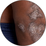 Plaque psoriasis on darker skin tone