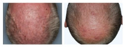 Thumbnail of plaque psoriasis STYLE results at week 16 on the scalp of a male Otezla patient