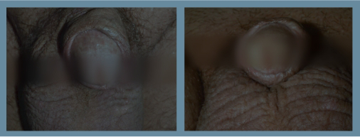 Baseline and week 16 results seen in Otezla® (apremilast) patients