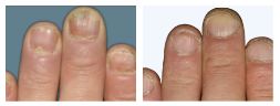 Thumbnail of plaque psoriasis PASI-76.2 results at Week 16 in the fingers of an Otezla patient