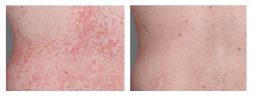 Thumbnail of plaque psoriasis PASI-69 results at week 16 on the back of an Otezla patient