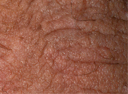 Genital psoriasis improvement after Otezla® (apremilast) treatment at week 16