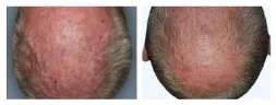 Thumbnail of plaque psoriasis STYLE results at week 16 on the scalp of a male Otezla patient