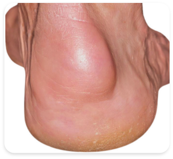 Image of a swollen foot due to psoriatic arthritis