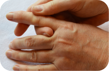 Image of hands with psoriatic arthritis