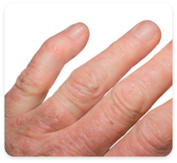 Patient's fingers with joint tenderness and swelling from psoriatic arthritis