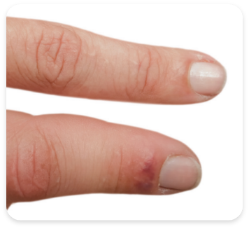 Patient with swollen fingers from psoriatic arthritis