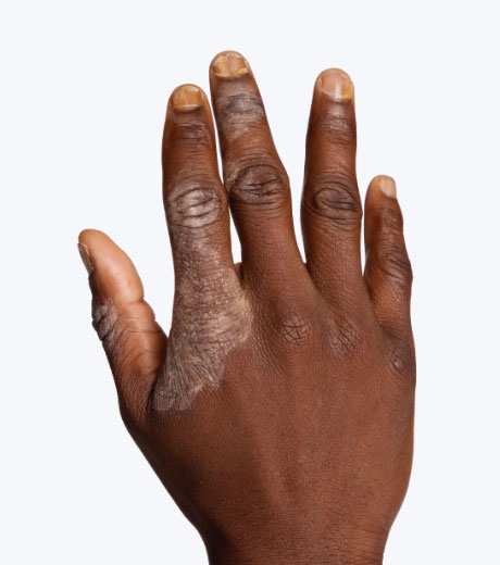 Darker skin tone hand with plaque psoriasis on skin and nails