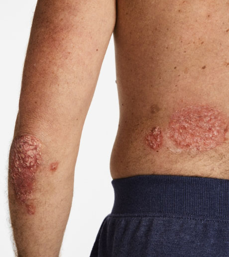 Hypothetical patient with plaque psoriasis on their elbow and back