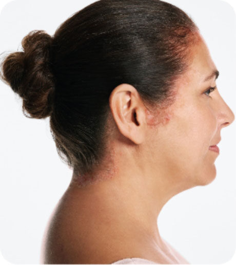 Hypothetical patient with scalp psoriasis