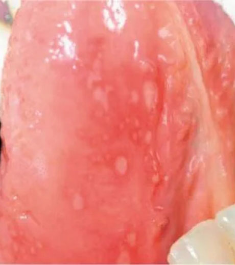 Oral ulcers on the tongue